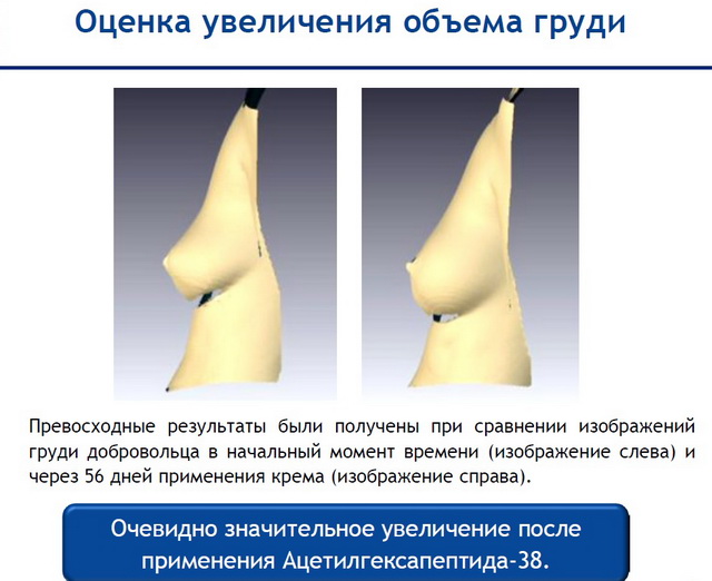 Действие Adifyline  - оценка увеличения объема груди
